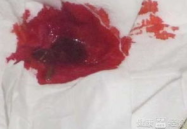 拉大便出血鲜红但是不疼,常见原因及应对策略”